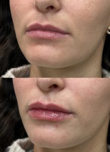 lipfillerforanaturallook